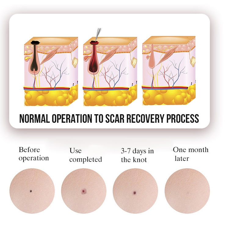 FY-106 Portable Mole and Freckle Removal Pen Household Laser Beauty Equipment, FY-106 (Rose Gold), FY-106 (Gold), FY-106 (Green), FY-106 (Blue)
