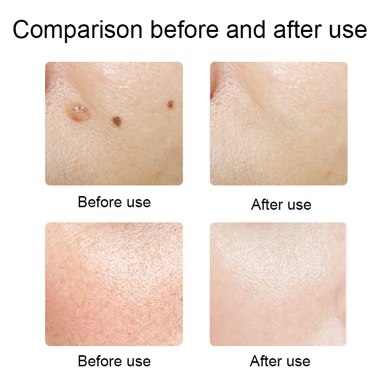 FY-106 Portable Mole and Freckle Removal Pen Household Laser Beauty Equipment, FY-106 (Rose Gold), FY-106 (Gold), FY-106 (Green), FY-106 (Blue)